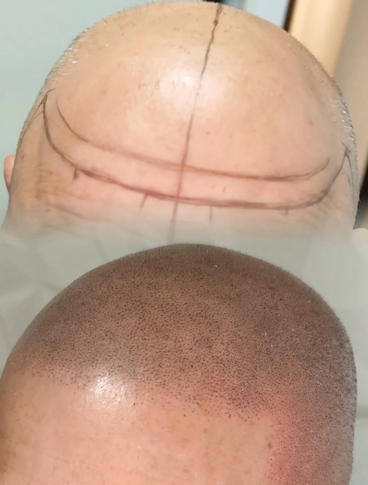 Scalp